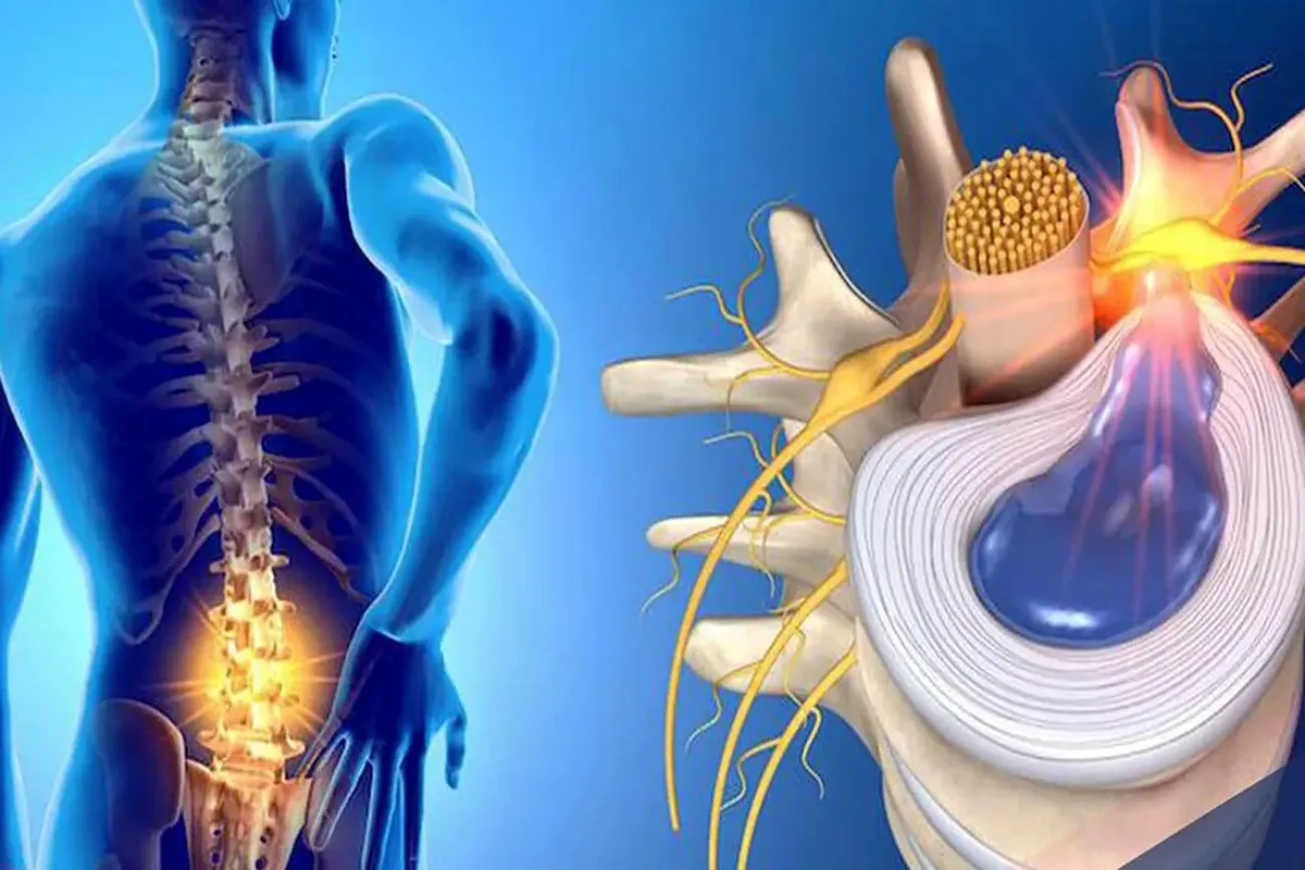 علائم دیسک کمر؛ نشانه‌هایی که نباید نادیده گرفته شوند