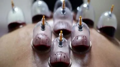 حجامت توسط افراد غیر متخصص خطرناک است
