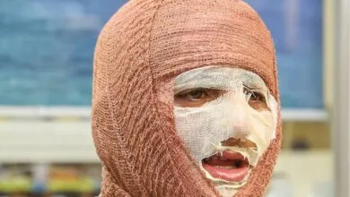 «جان نو» به کمک بیماران سوختگی میآید