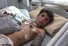 یک جراحی کم‌نظیر در بروجرد؛ دست قطع‌شده نوجوان دوباره به بدن بازگشت